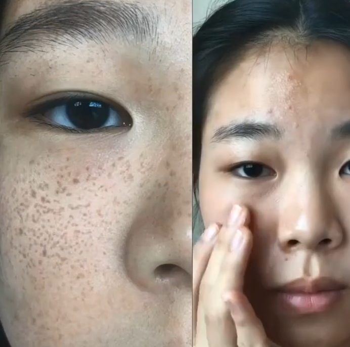 Whitening Freckle Cream  Removal Chloasma Spots  Removes Melanin and Sooth Treatment Reduces Redness and Swelling Brightens Skin Tone Whitening Cream
